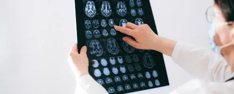 Scientific visualization of Alzheimer's disease research showing brain pathology